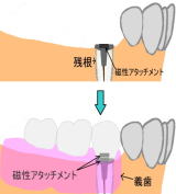 残根に磁性アタッチメントをし入れ義歯を載せた場合