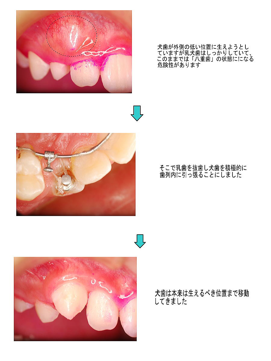 外科的挺出説明図