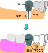 残根上の冠にクラスプをかけた図