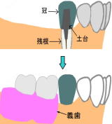 残根上の冠にクラスプをかけない場合