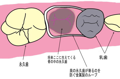 クラウンループ