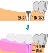 残根に蓋をし義歯を載せた場合