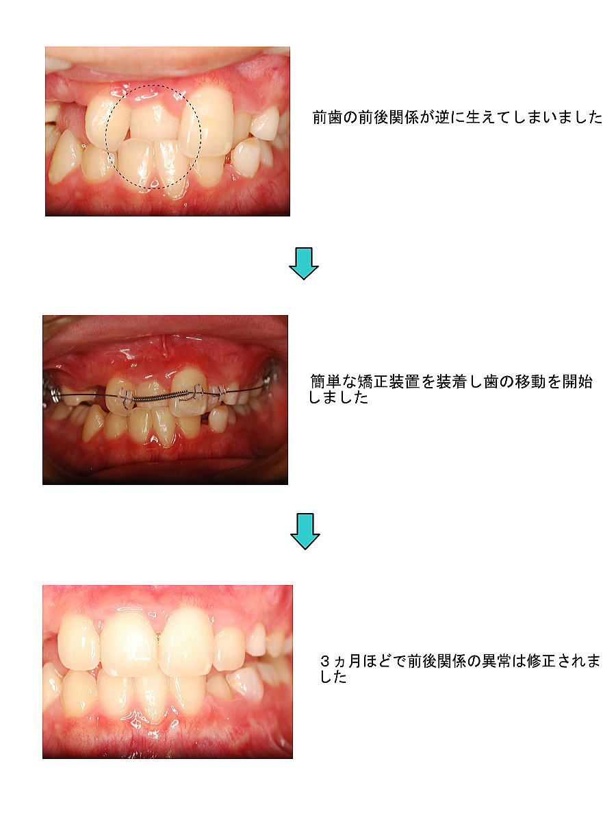 前歯反対咬合治療図